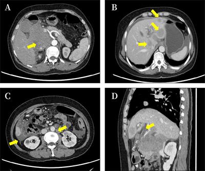 Pancreatic diffuse large B-cell lymphoma: a case report and literature review